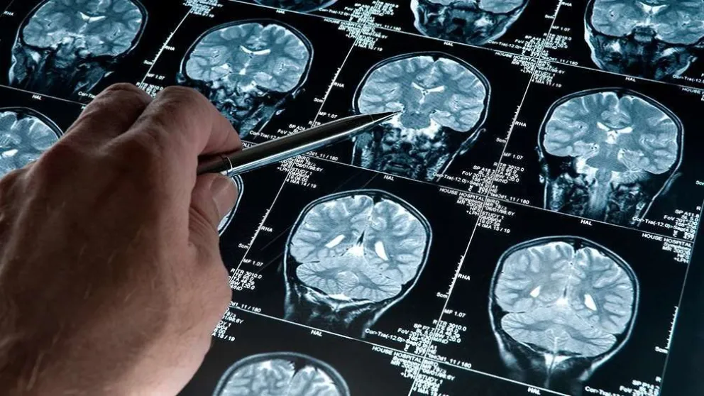Identificaron un mecanismo que podría mejorar el efecto de la quimioterapia